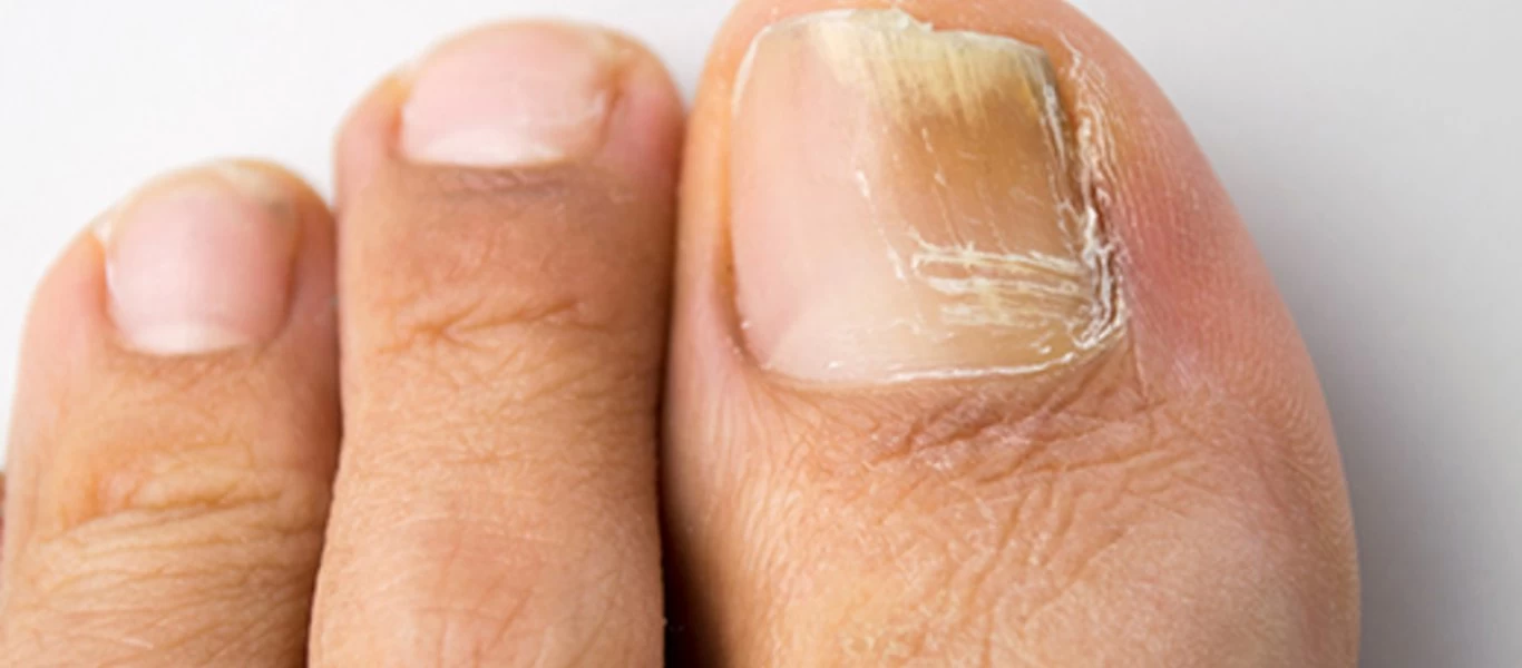 Μύκητες στα νύχια χεριών και ποδιών: Οκτώ κανόνες πρόληψης